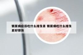 银屑病应该吃什么维生素 银屑病吃什么维生素好得快