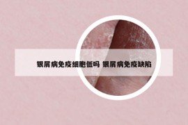 银屑病免疫细胞低吗 银屑病免疫缺陷