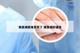 银屑病我难受死了 银屑病好痛苦