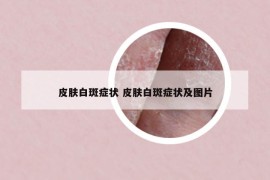 皮肤白斑症状 皮肤白斑症状及图片