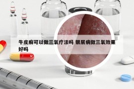 牛皮癣可以做三氧疗法吗 银屑病做三氧效果好吗