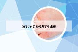 孩子7岁的时候患了牛皮癣