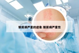 银屑病严重的迹象 银屑病严重性