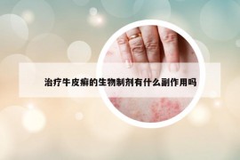 治疗牛皮癣的生物制剂有什么副作用吗