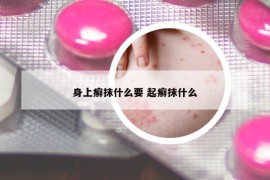 身上癣抹什么要 起癣抹什么