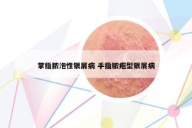 掌指脓泡性银屑病 手指脓疱型银屑病