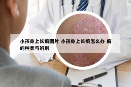 小孩身上长癣图片 小孩身上长癣怎么办 癣的种类与辨别