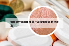 银屑病针灸副作用 第一次得银屑病 用针灸治