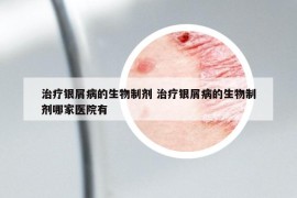 治疗银屑病的生物制剂 治疗银屑病的生物制剂哪家医院有