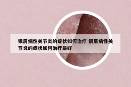 银屑病性关节炎的症状如何治疗 银屑病性关节炎的症状如何治疗最好