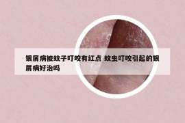 银屑病被蚊子叮咬有红点 蚊虫叮咬引起的银屑病好治吗