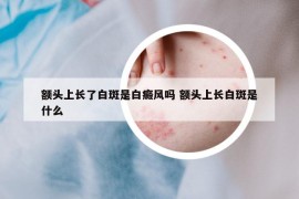 额头上长了白斑是白癜风吗 额头上长白斑是什么