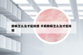 脚癣怎么治才能除根 手癣脚癣怎么治才能除根