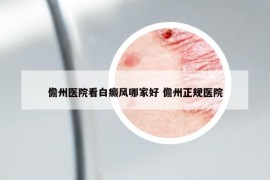 儋州医院看白癜风哪家好 儋州正规医院