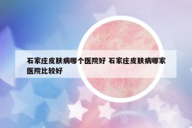 石家庄皮肤病哪个医院好 石家庄皮肤病哪家医院比较好