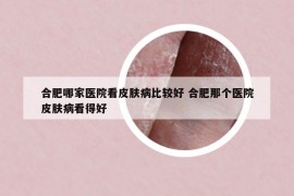 合肥哪家医院看皮肤病比较好 合肥那个医院皮肤病看得好