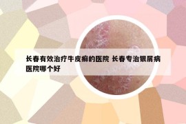 长春有效治疗牛皮癣的医院 长春专治银屑病医院哪个好