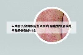 人为什么会得脓疱型银屑病 脓疱型银屑病是不是身体缺少什么