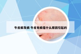 牛皮癣发病 牛皮有癣是什么原因引起的