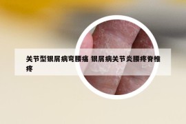 关节型银屑病弯腰痛 银屑病关节炎腰疼脊椎疼