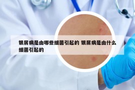 银屑病是由哪些细菌引起的 银屑病是由什么细菌引起的