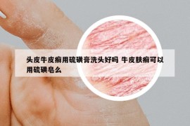 头皮牛皮癣用硫磺膏洗头好吗 牛皮肤癣可以用硫磺皂么