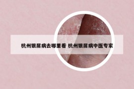 杭州银屑病去哪里看 杭州银屑病中医专家