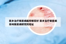 新乡治疗银屑病医院哪家好 新乡治疗银屑病郑州银屑病研究院地址