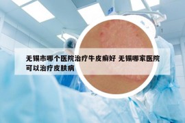 无锡市哪个医院治疗牛皮癣好 无锡哪家医院可以治疗皮肤病