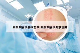 银屑病舌头胖大齿痕 银屑病舌头症状图片