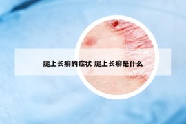 腿上长癣的症状 腿上长癣是什么