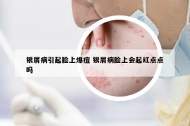 银屑病引起脸上爆痘 银屑病脸上会起红点点吗