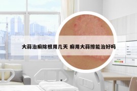 大蒜治癣除根用几天 癣用大蒜擦能治好吗