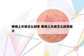 眼睛上长癣怎么回事 眼睛上长癣怎么回事图片