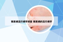 银屑病流行病学调查 银屑病的流行病学