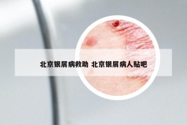 北京银屑病救助 北京银屑病人贴吧