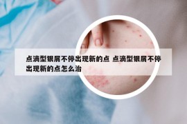 点滴型银屑不停出现新的点 点滴型银屑不停出现新的点怎么治