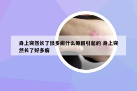 身上突然长了很多癣什么原因引起的 身上突然长了好多癣