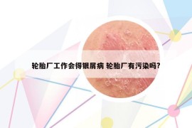 轮胎厂工作会得银屑病 轮胎厂有污染吗?