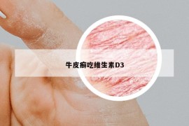 牛皮癣吃维生素D3