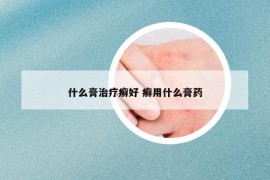 什么膏治疗癣好 癣用什么膏药