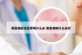 银屑病应该经常喝什么水 银屑病喝什么水好