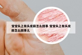 宝宝头上有头皮藓怎么回事 宝宝头上有头皮藓怎么回事儿