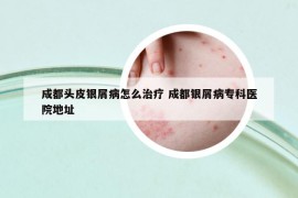 成都头皮银屑病怎么治疗 成都银屑病专科医院地址