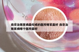 南京治银屑病最权威的医院哪家最好 南京治银屑病哪个医院最好