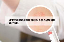 儿童点滴型银屑病能治愈吗 儿童点滴型银屑病好治吗