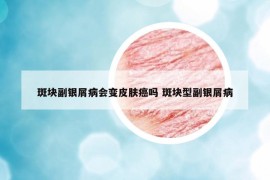 斑块副银屑病会变皮肤癌吗 斑块型副银屑病