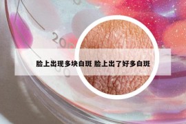 脸上出现多块白斑 脸上出了好多白斑