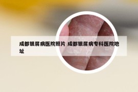 成都银屑病医院照片 成都银屑病专科医院地址