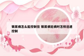 银屑病怎么能控制住 银屑病犯病时怎样迅速控制